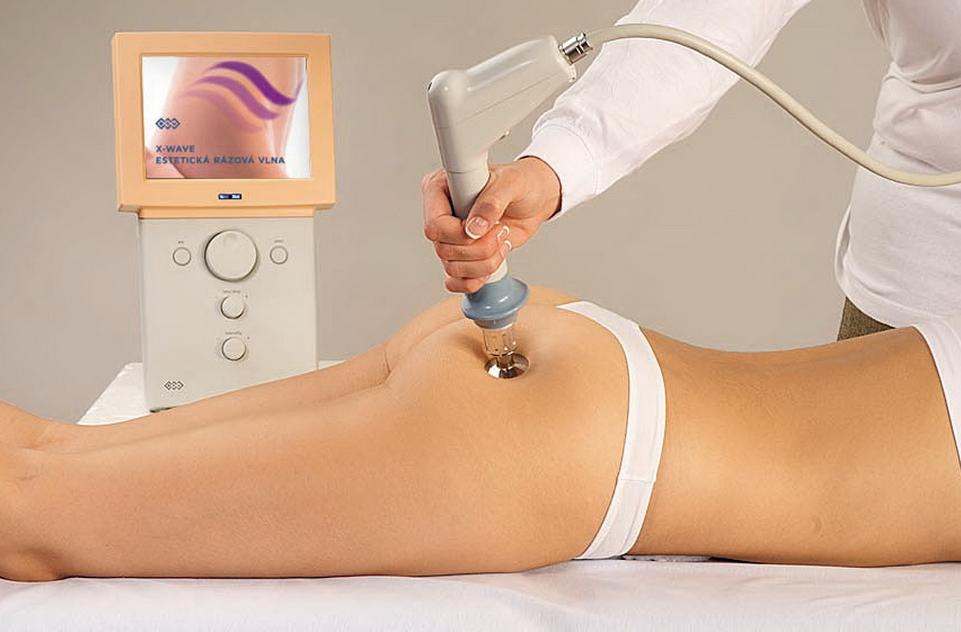 Estetická Rázová vlna X-Wave, Pohybová RV ESWT