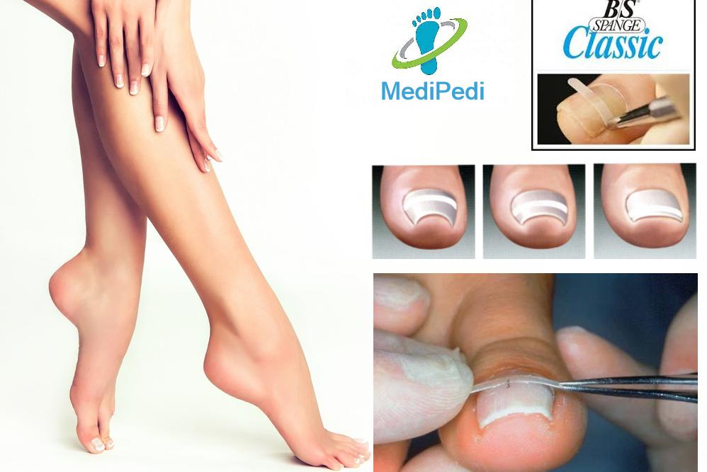 Ortonyxie - rovnání deformovaných zarostlých nehtů