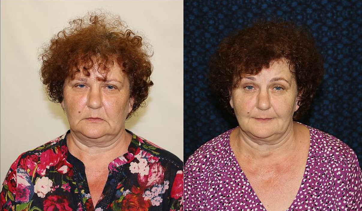 Obličejová jóga Kateřiny Schlosserové foto 3