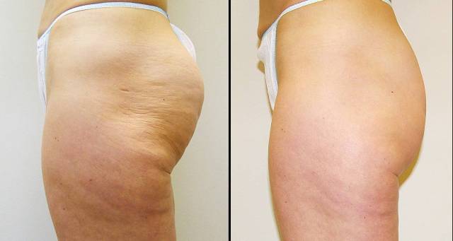 Masáže - BeautyShape center foto 4