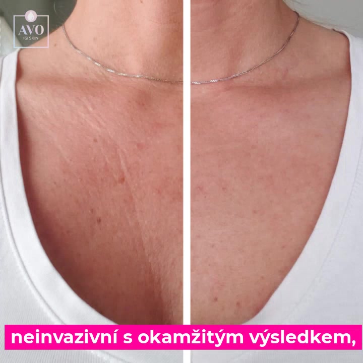 AVO IQ SKIN foto 2 (náhled videa)