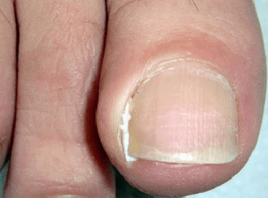 Tamponování - při problémech se zarostlým nehtem