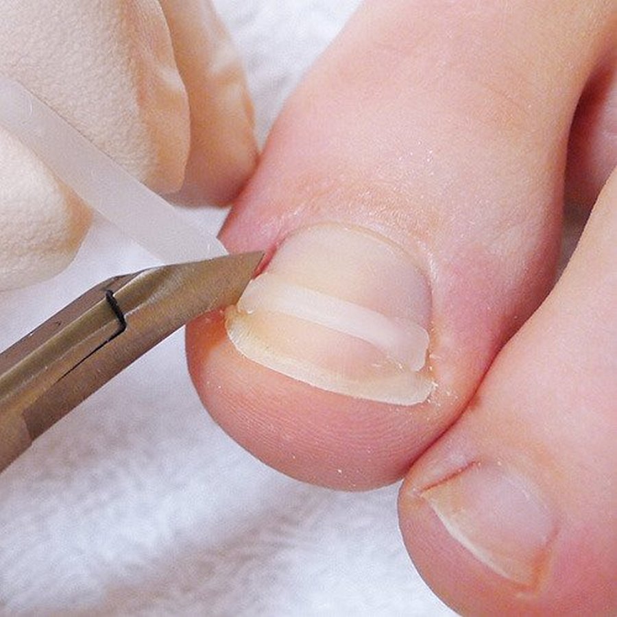 B/S spony (rovnátka) - korekce nehtů