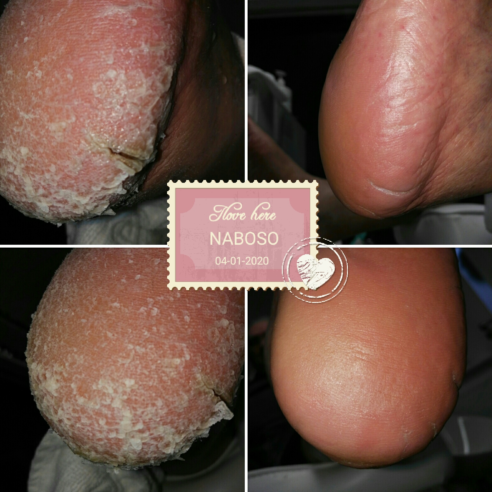 Pedikúra NABOSO foto 4