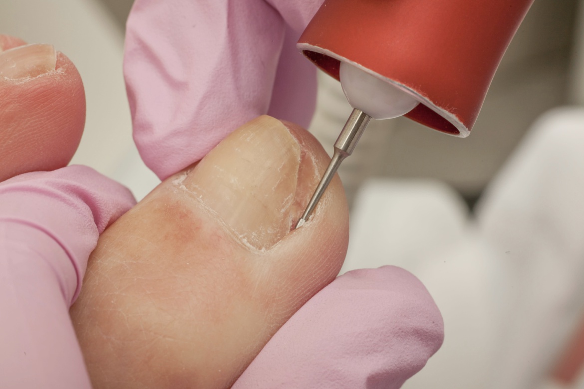 Suchá pedikúra s ošetřením zarostlých nehtů