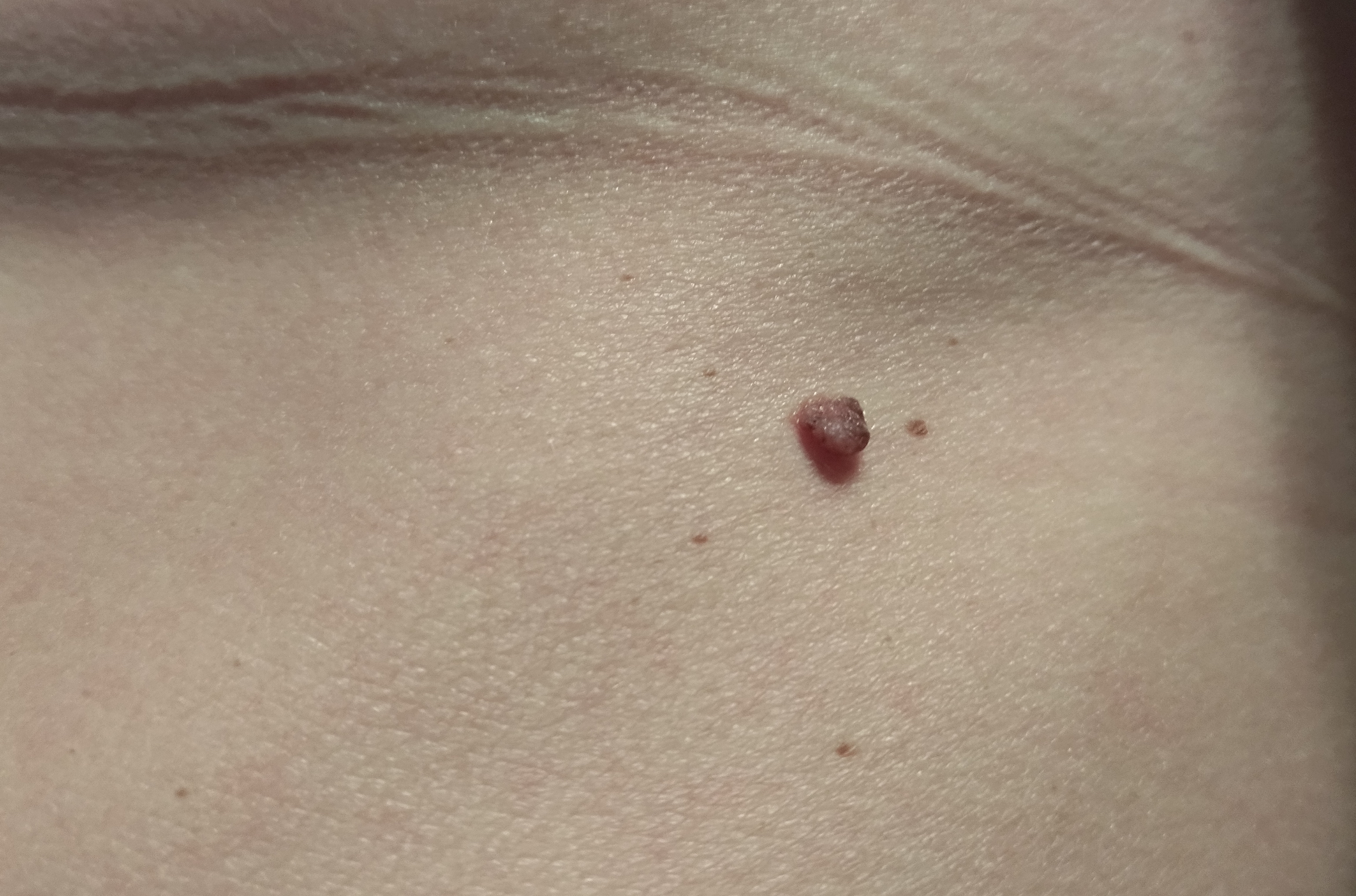 Odstranění kožních výrůstků při jedné návštěvě