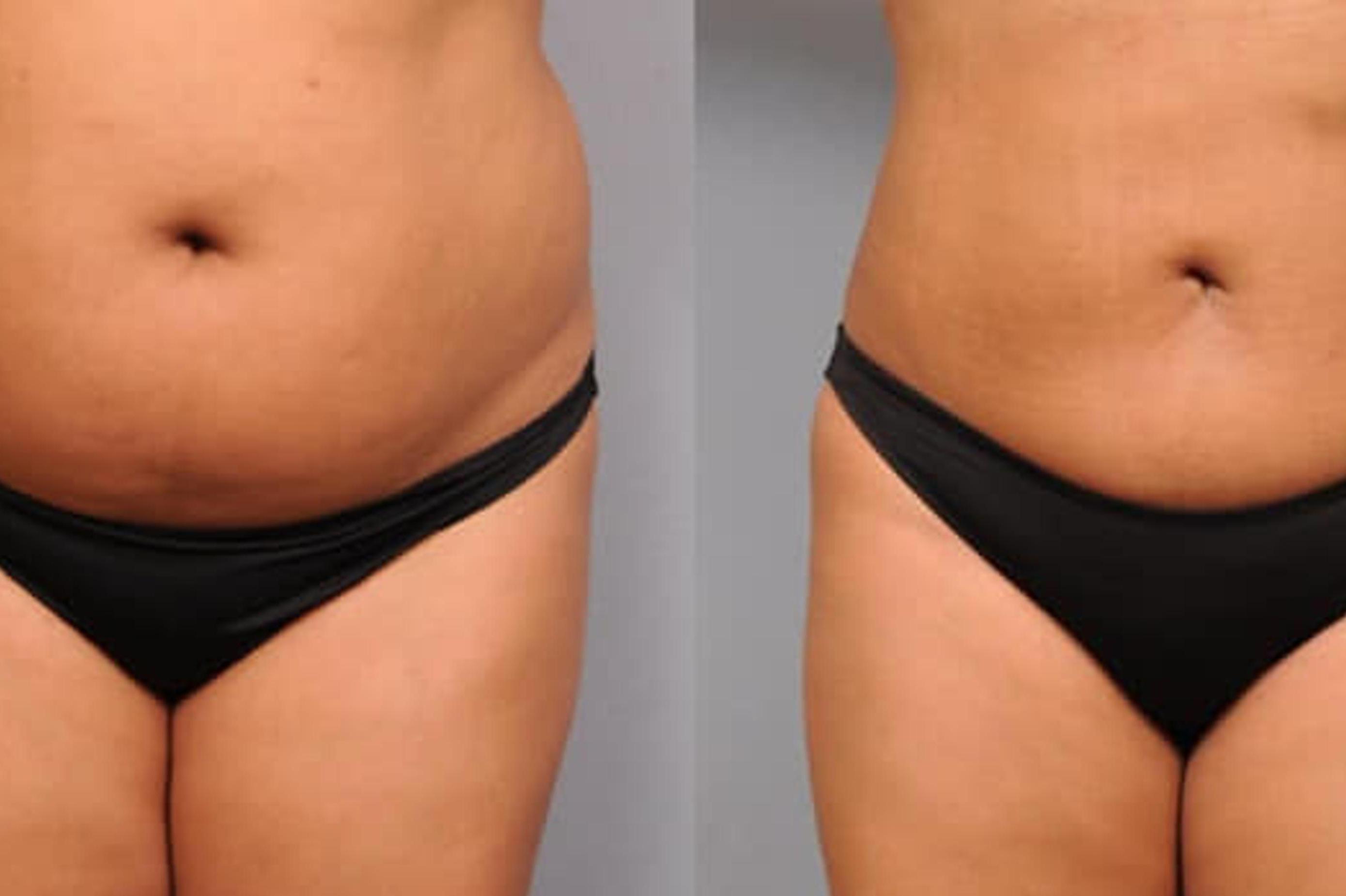 Zeštíhlení přístrojem LIPOSONIX tělo i obličej