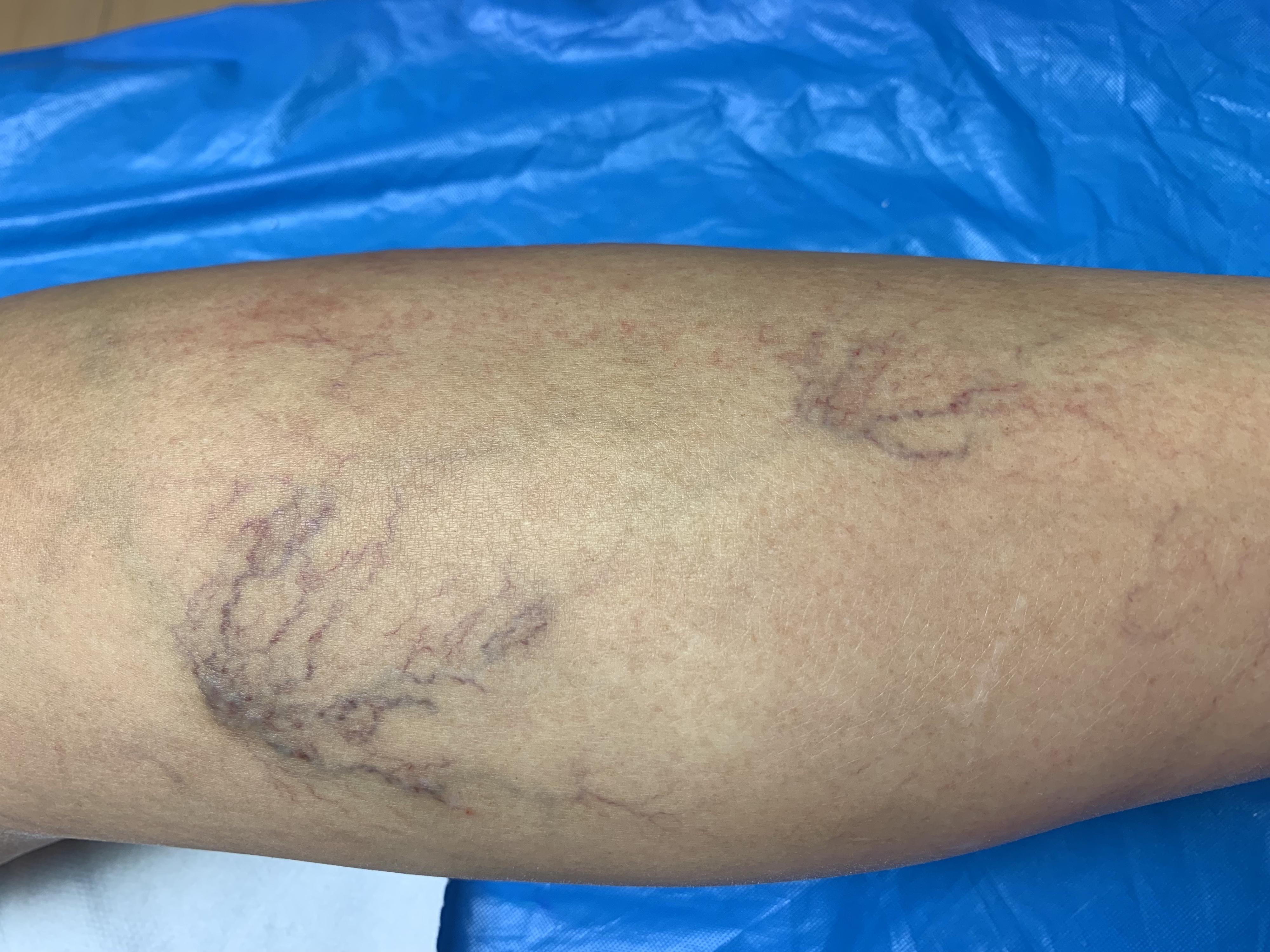 Sklerotizace křečových žil a metličkových žilek