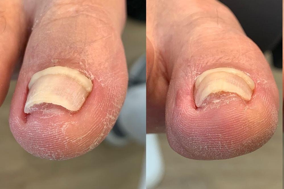 Nehtové rovnátko z kompozitu