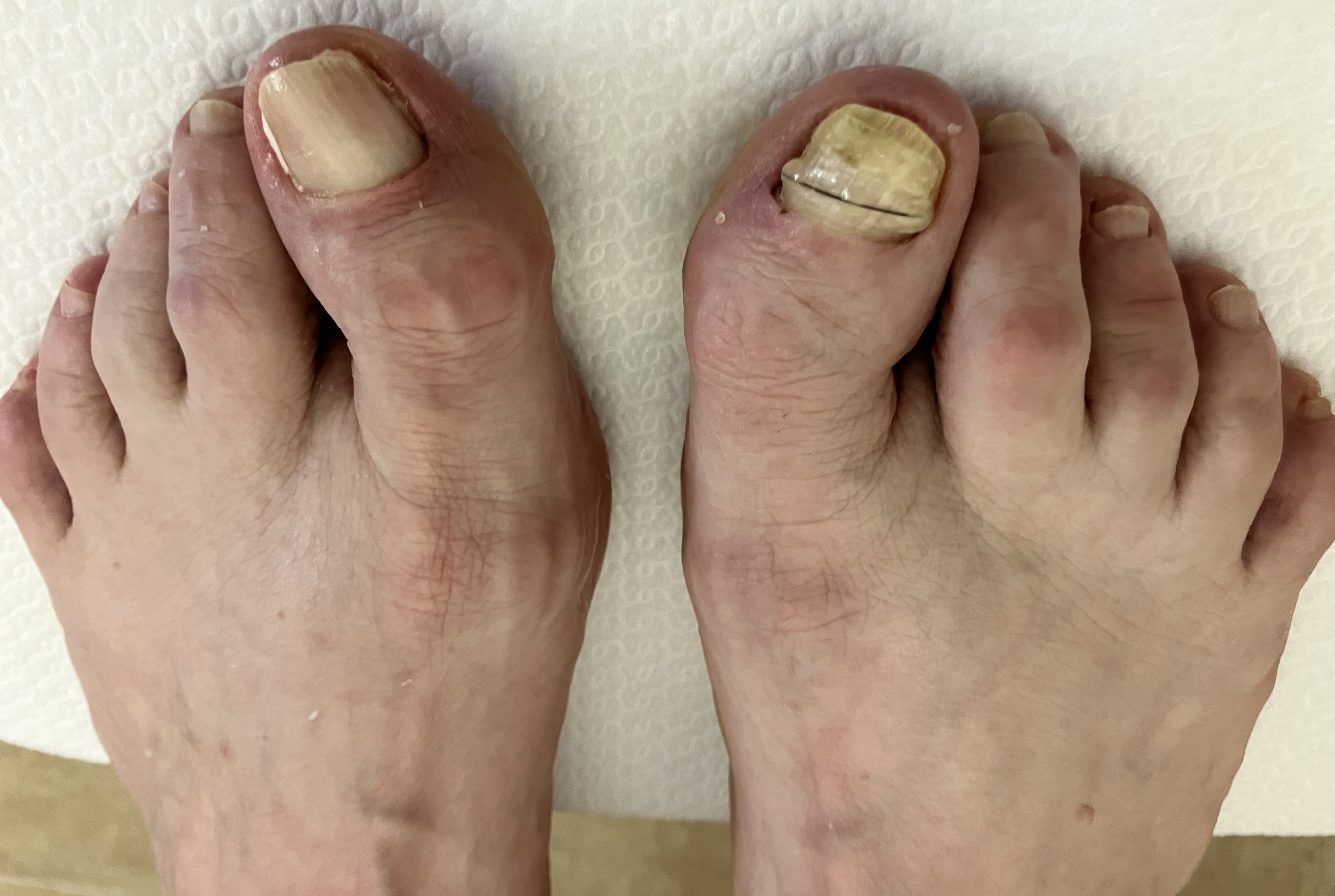 Ošetření zarostlého nehtu