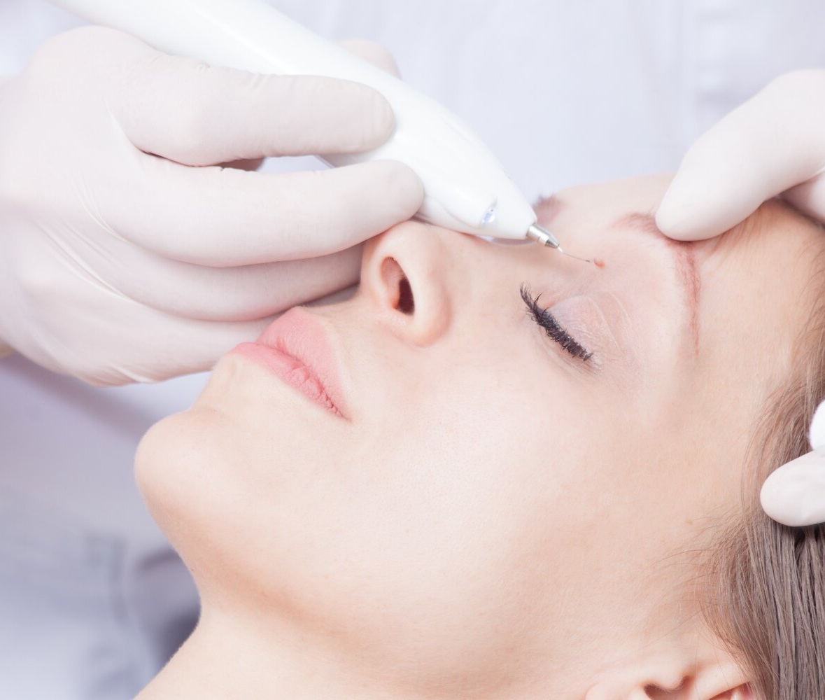 Odstranění milií - přístrojově