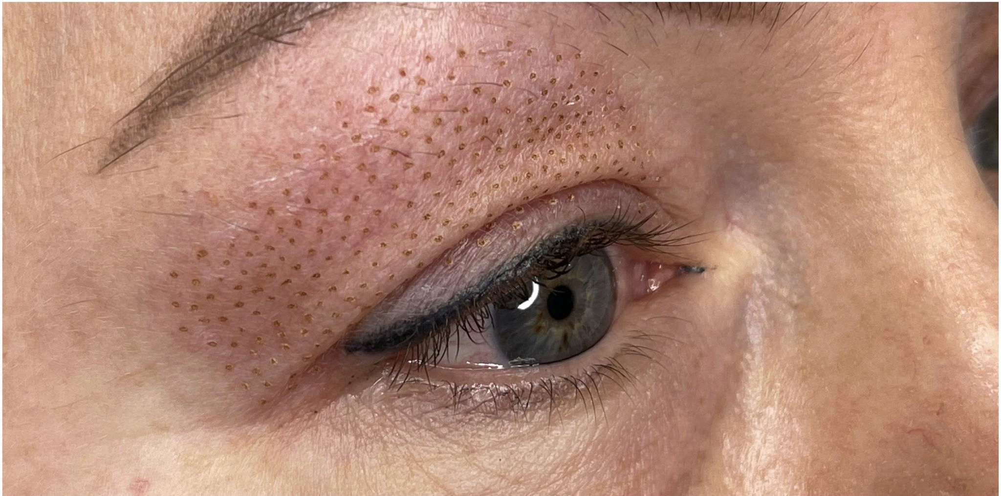 Plasma lifting - ošetření teplou plasmou