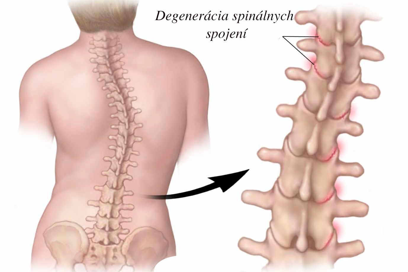 Cvičení proti skolióze Plzeň - INDIVIDUÁLNÍ LEKCE
