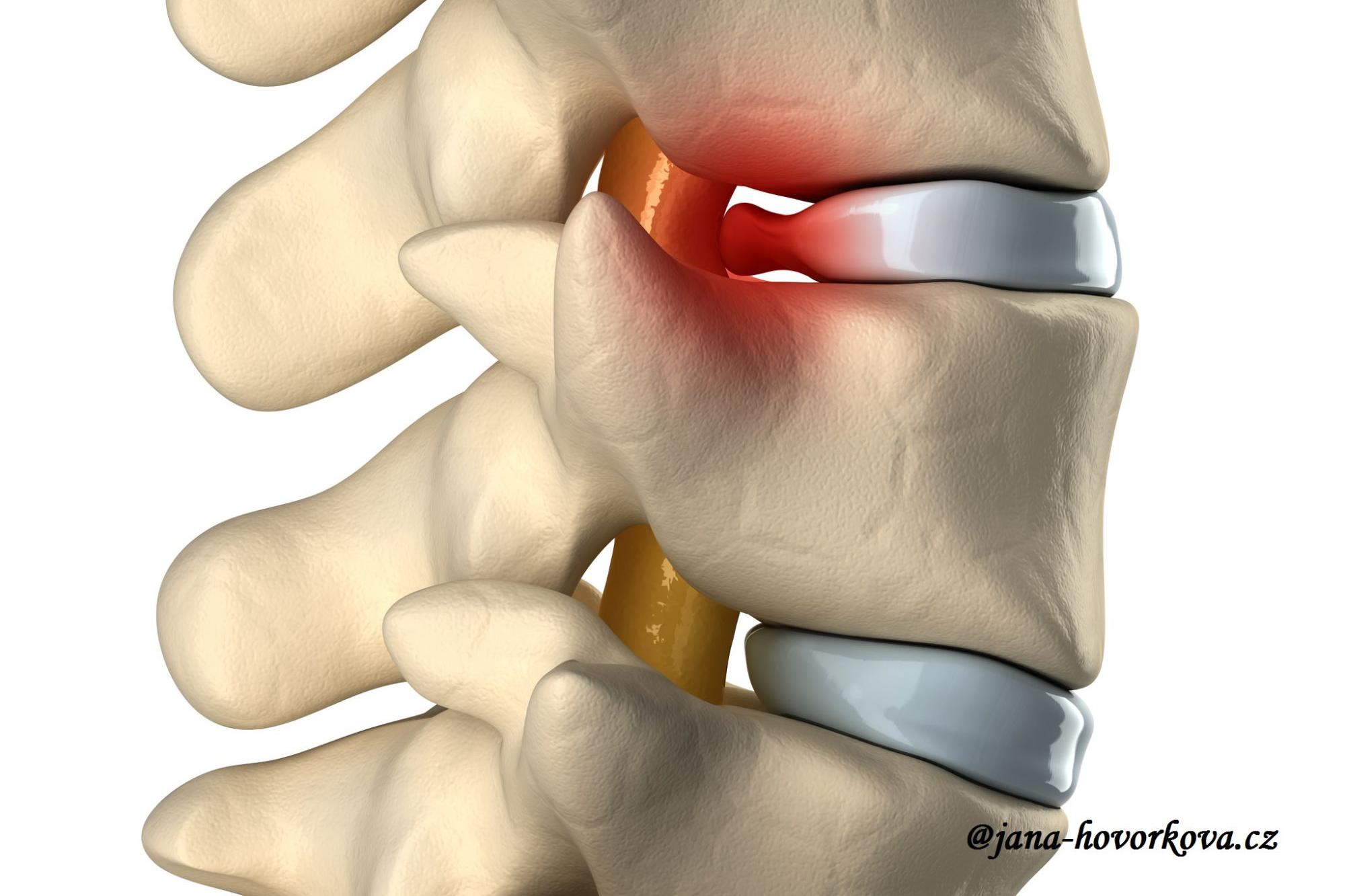 Rehabilitace po výhřezu ploténky SM systém