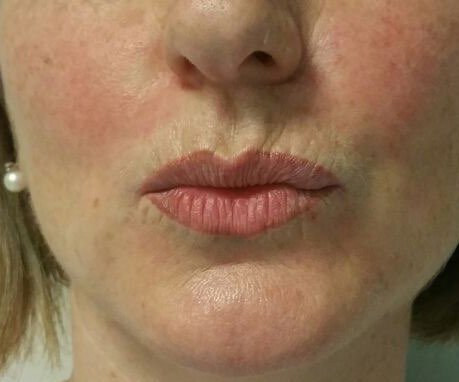 Modelace rtů kyselinou hyaluronovou
