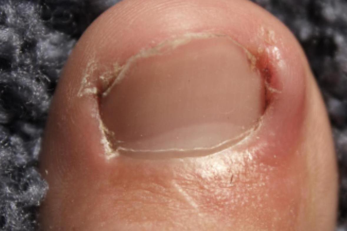 Ošetření zarostlého nehtu