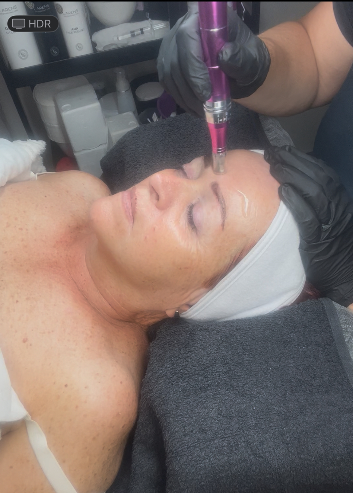 Mikrojehličkovaní - mezoterapie