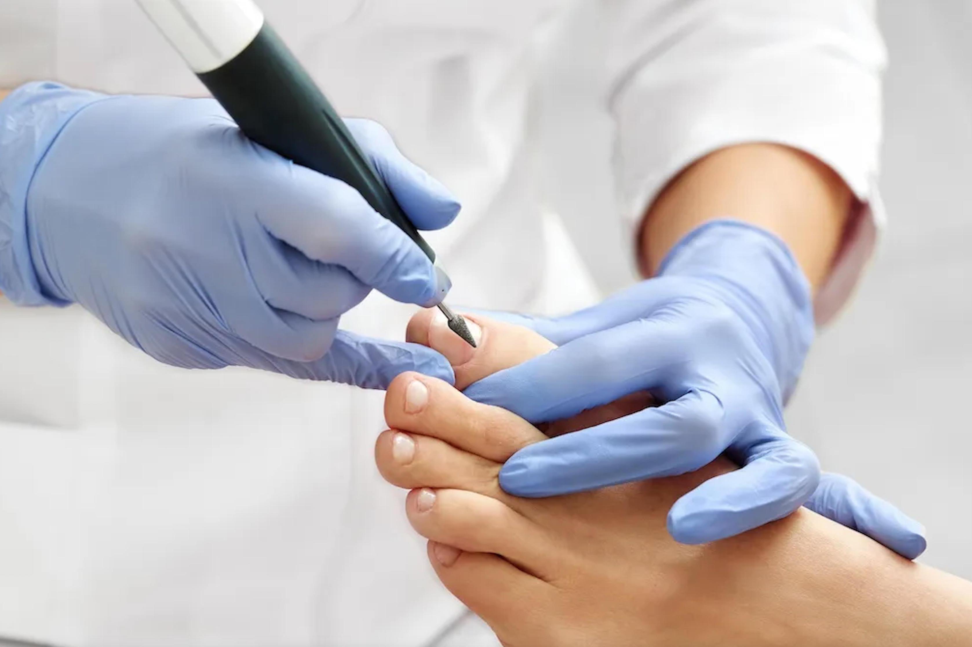 Odborné pedikérské ošetření suchou přístrojovou metodou