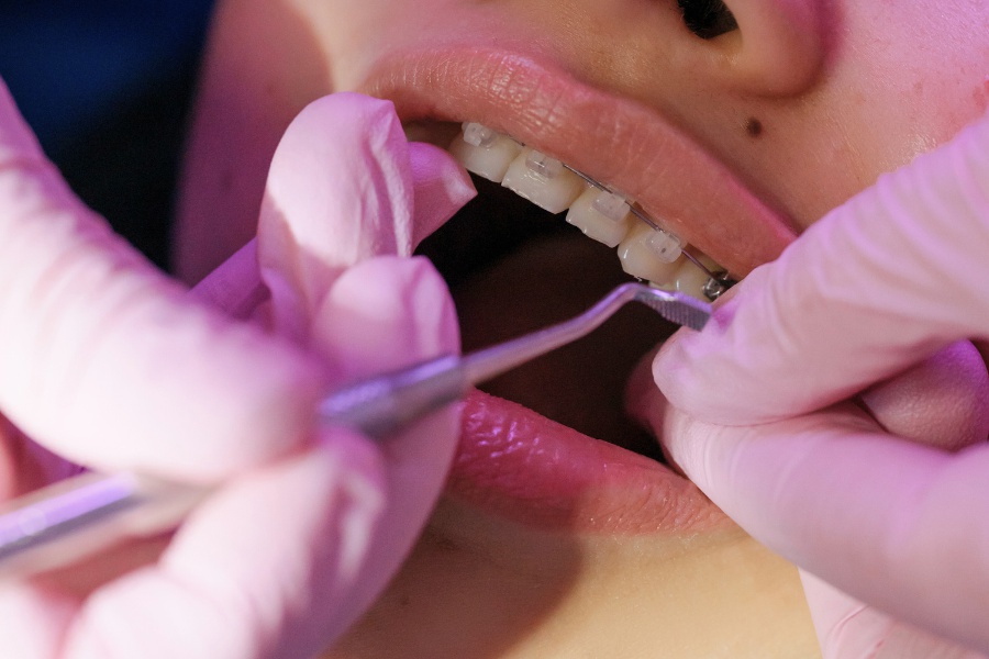 Dentální hygiena s rovnátky