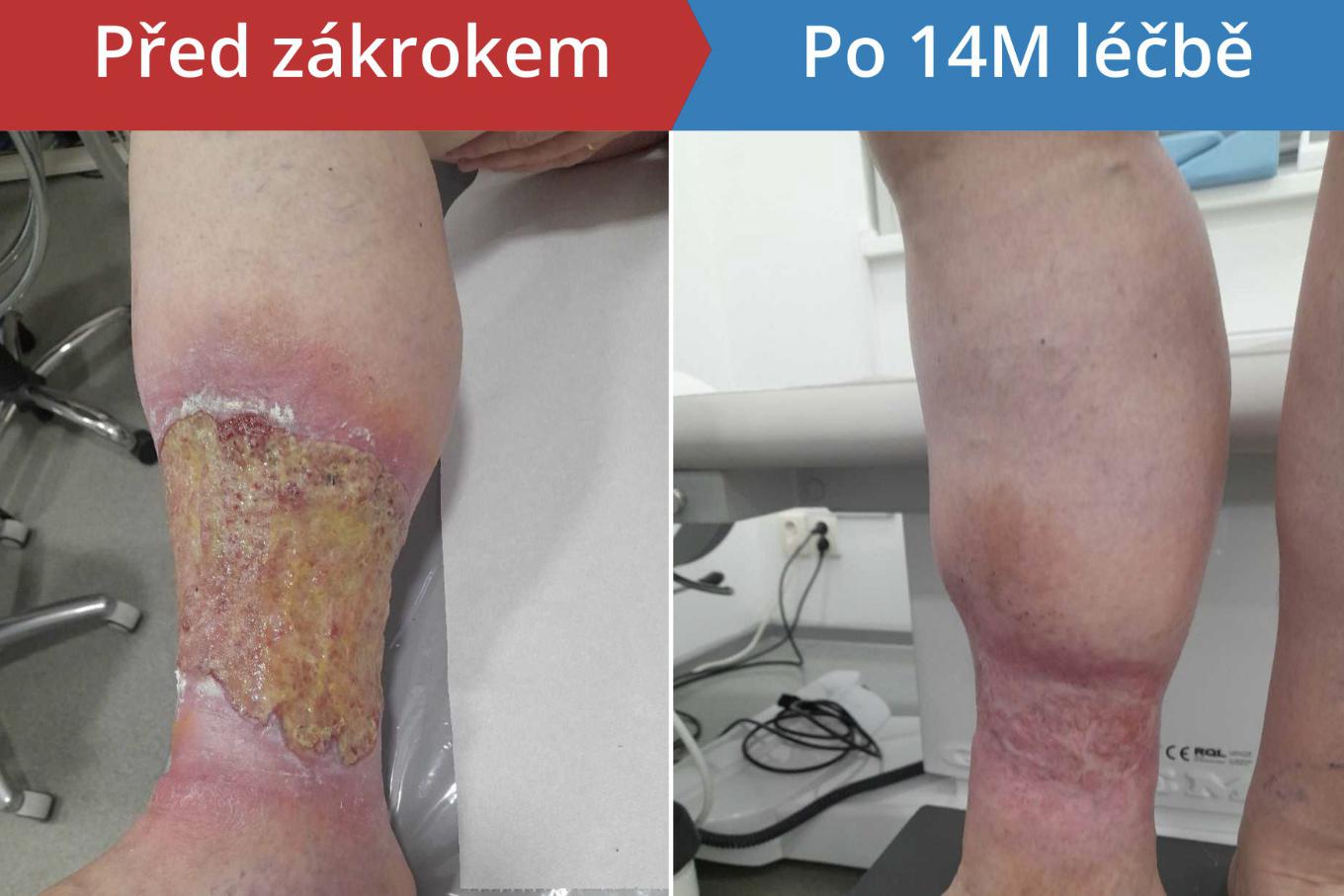 Ukázka léčby bércových vředů