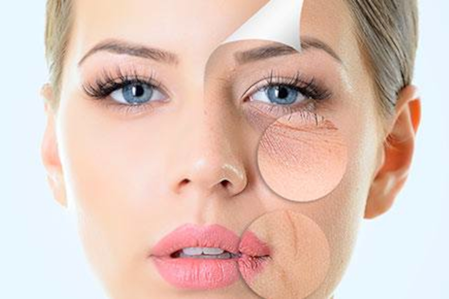 Odstranění mimických vrásek - Botulotoxin