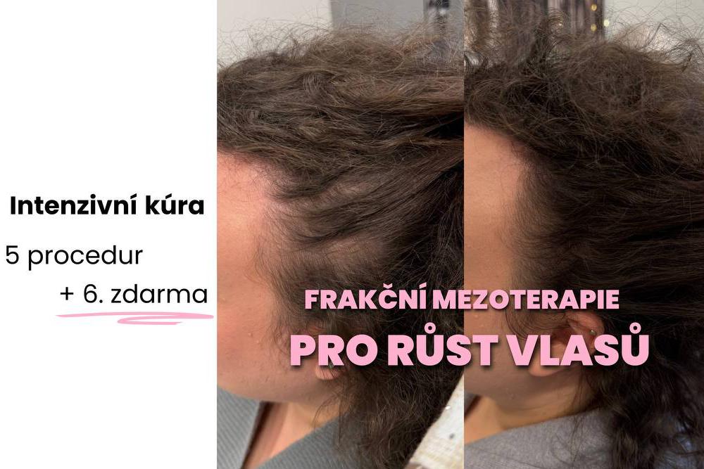 PADAJÍ VÁM VLASY? Frakční mezoterapie pomůže!