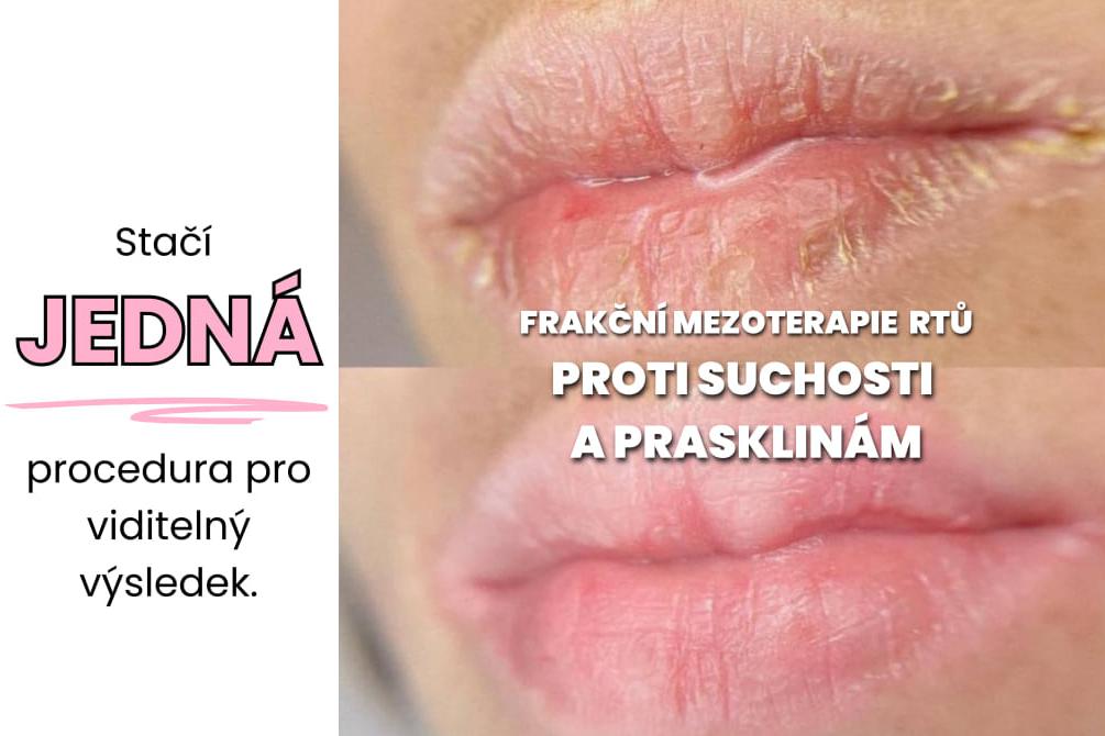 HYDRATACE A VÝŽIVA RTŮ bez každodenního balzámu!