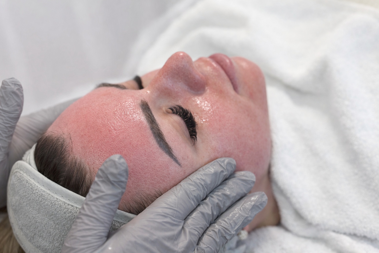 Biomicroneedling