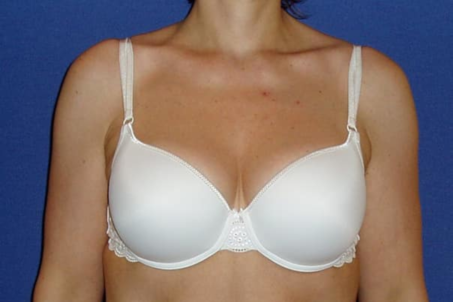 Redukce a modelace prsů