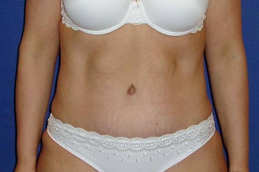 Abdominoplastika - Plastika břicha