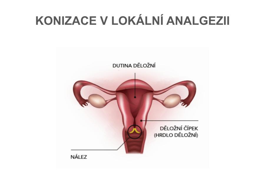 Konizace děložního čípku