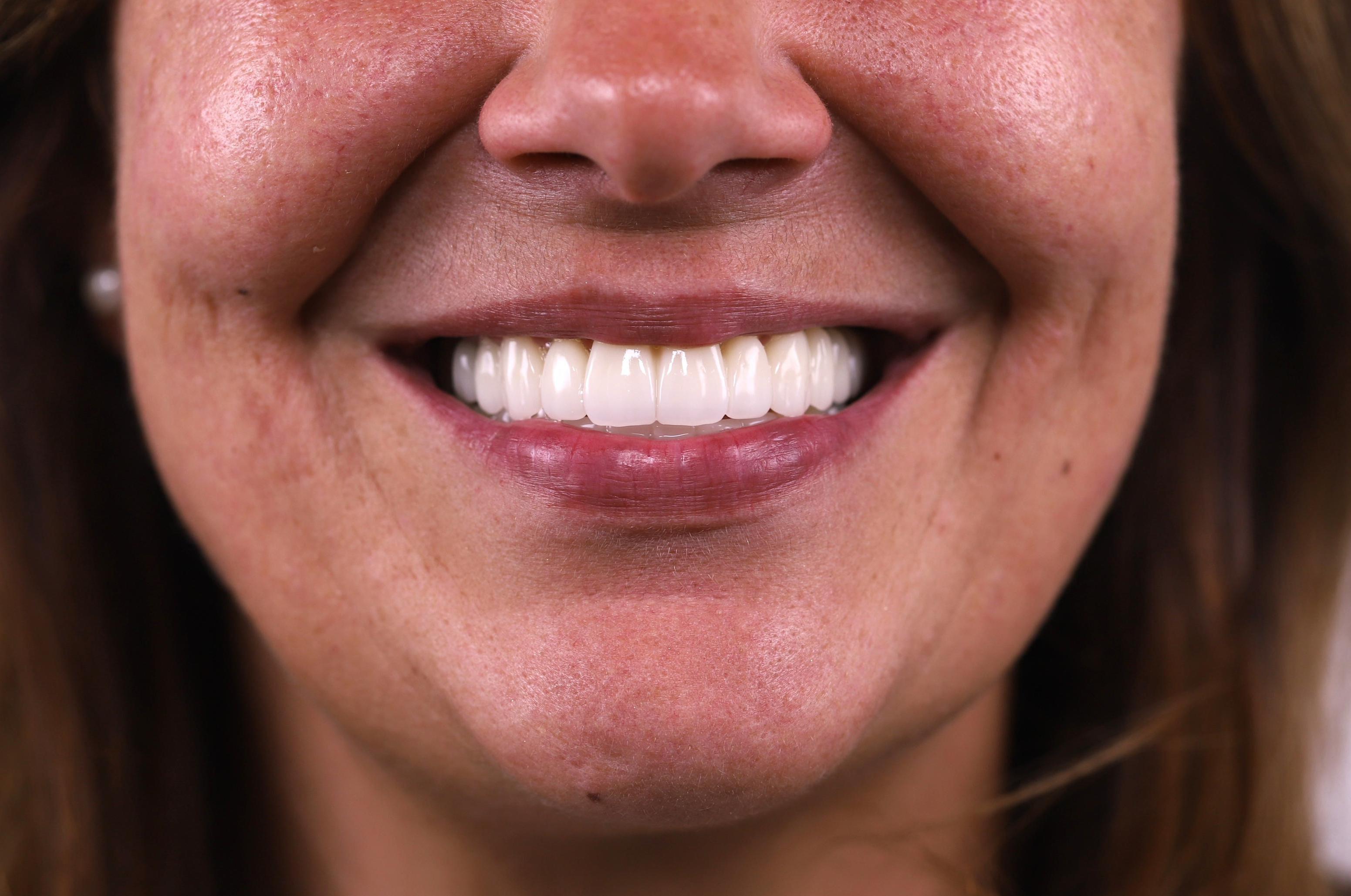 All-on-4-implantaty.cz - dSmile