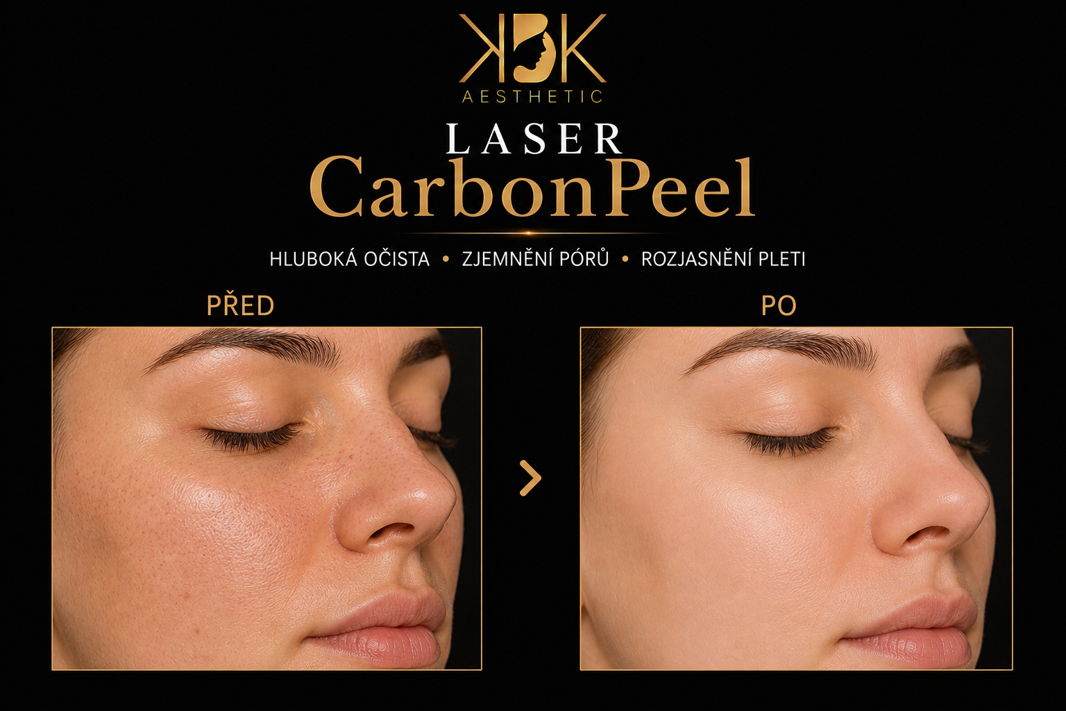 Carbon Peel