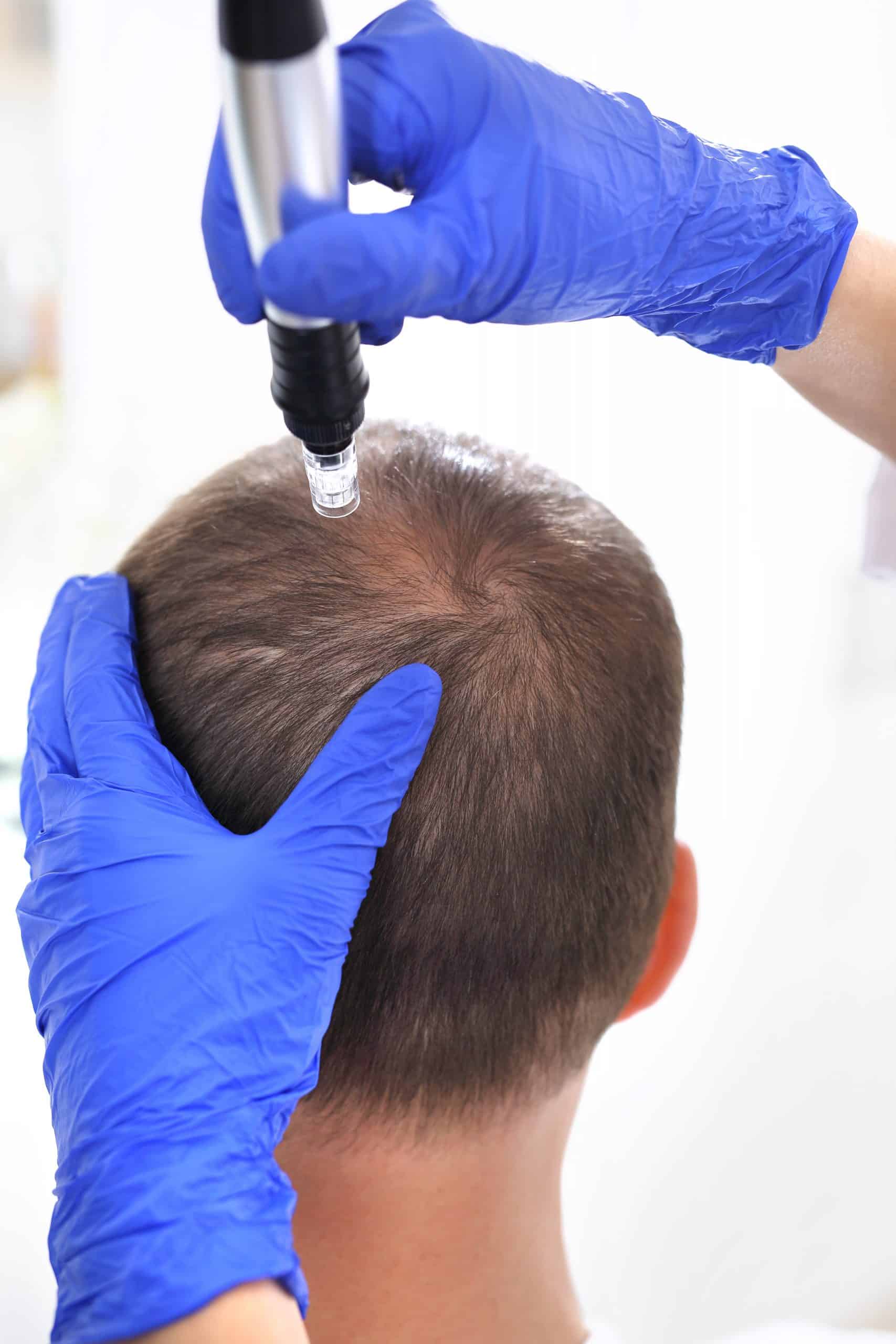 Mikrojehličkování vlasové pokožky - hair rejuvenation therapy
