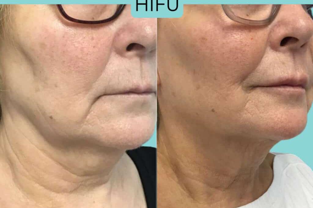 HIFU - ultrazvukový lifting, bezbolestná liposukce